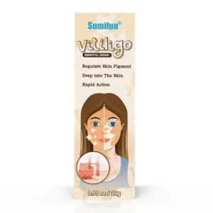Faith Sumifun Vitiligo Removal Cream Natural White Spot Treatment Leucoplakia Acting 20g